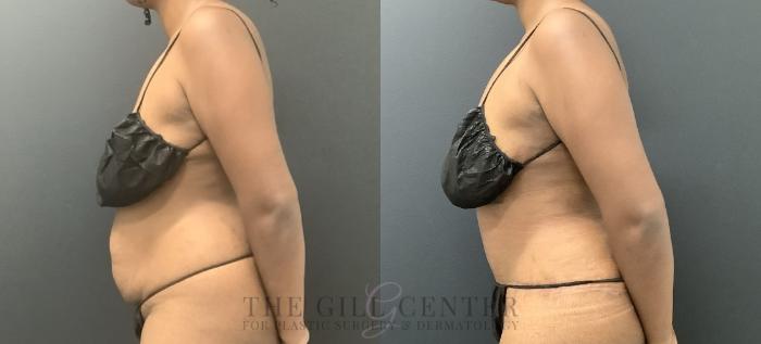 Tummy Tuck Case 721 Before & After Left Side | The Woodlands, TX | The Gill Center for Plastic Surgery and Dermatology