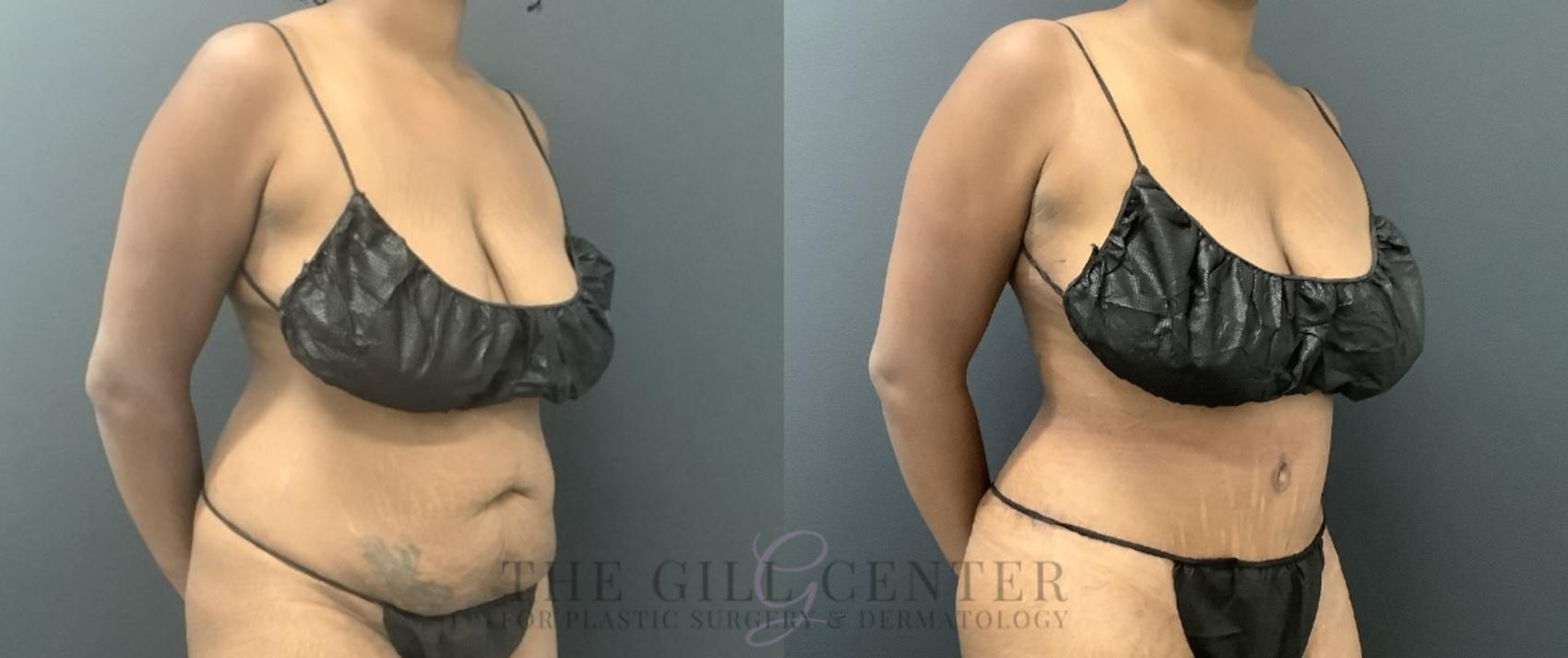 Tummy Tuck Case 721 Before & After Right Oblique | The Woodlands, TX | The Gill Center for Plastic Surgery and Dermatology