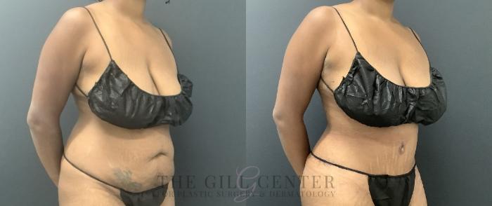 Tummy Tuck Case 721 Before & After Right Oblique | The Woodlands, TX | The Gill Center for Plastic Surgery and Dermatology