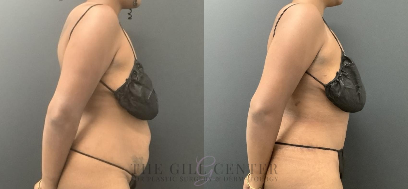 Tummy Tuck Case 721 Before & After Right Side | The Woodlands, TX | The Gill Center for Plastic Surgery and Dermatology