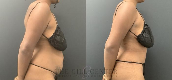 Tummy Tuck Case 721 Before & After Right Side | The Woodlands, TX | The Gill Center for Plastic Surgery and Dermatology