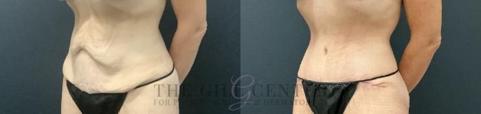 Tummy Tuck Case 723 Before & After Left Oblique | The Woodlands, TX | The Gill Center for Plastic Surgery and Dermatology