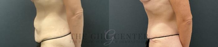 Tummy Tuck Case 723 Before & After Left Side | The Woodlands, TX | The Gill Center for Plastic Surgery and Dermatology