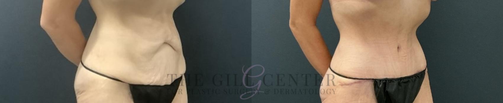 Tummy Tuck Case 723 Before & After Right Oblique | The Woodlands, TX | The Gill Center for Plastic Surgery and Dermatology