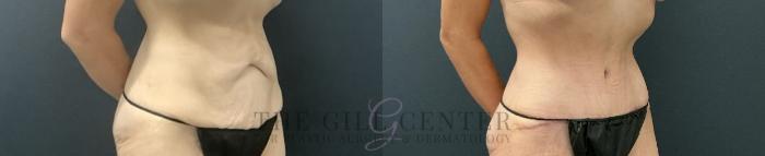 Tummy Tuck Case 723 Before & After Right Oblique | The Woodlands, TX | The Gill Center for Plastic Surgery and Dermatology