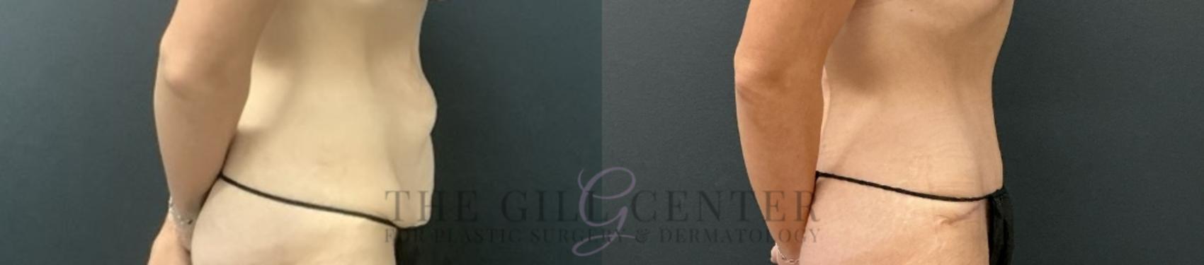 Tummy Tuck Case 723 Before & After Right Side | The Woodlands, TX | The Gill Center for Plastic Surgery and Dermatology