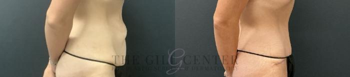 Tummy Tuck Case 723 Before & After Right Side | The Woodlands, TX | The Gill Center for Plastic Surgery and Dermatology