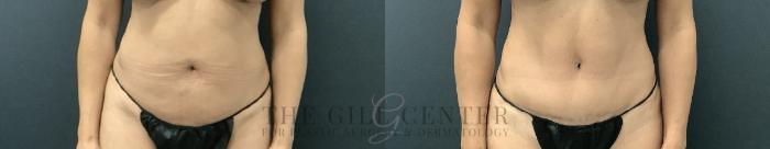 Tummy Tuck Case 727 Before & After Front | The Woodlands, TX | The Gill Center for Plastic Surgery and Dermatology