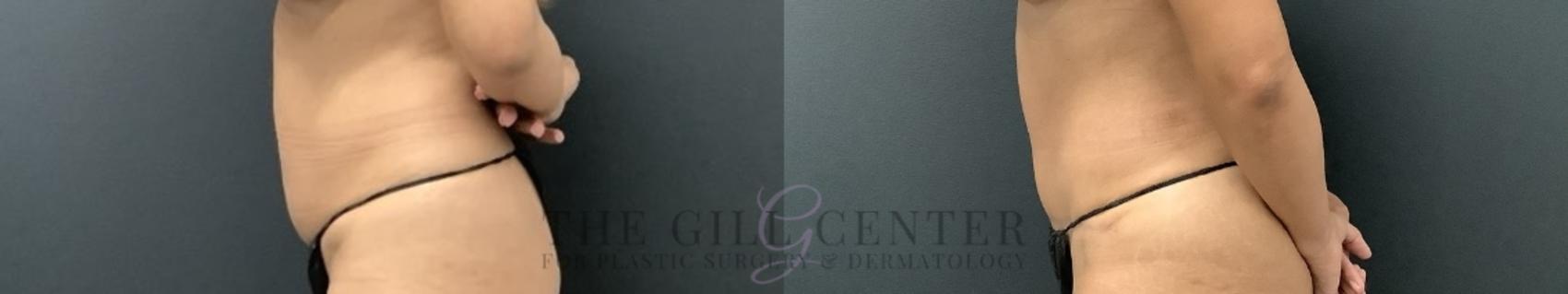 Tummy Tuck Case 727 Before & After Left Side | The Woodlands, TX | The Gill Center for Plastic Surgery and Dermatology