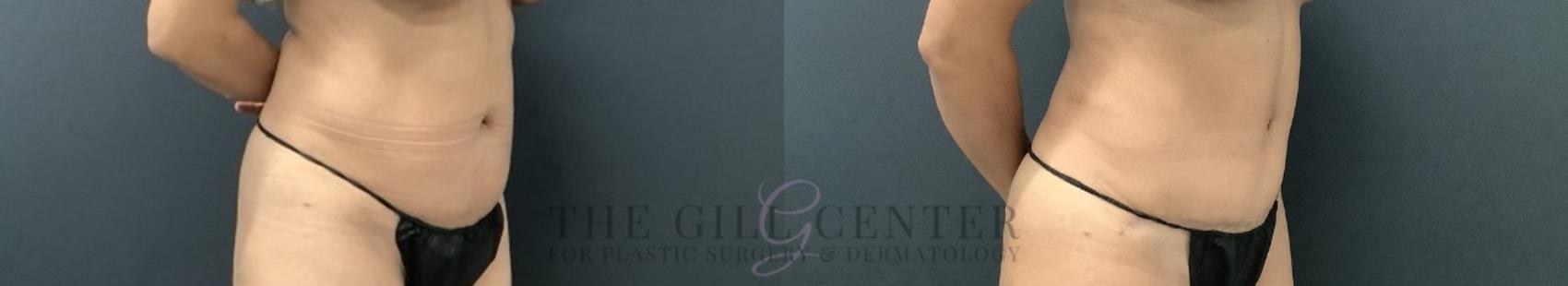Tummy Tuck Case 727 Before & After Right Oblique | The Woodlands, TX | The Gill Center for Plastic Surgery and Dermatology