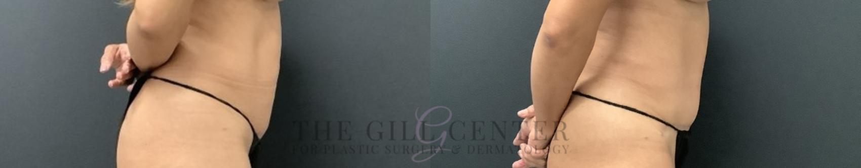 Tummy Tuck Case 727 Before & After Right Side | The Woodlands, TX | The Gill Center for Plastic Surgery and Dermatology