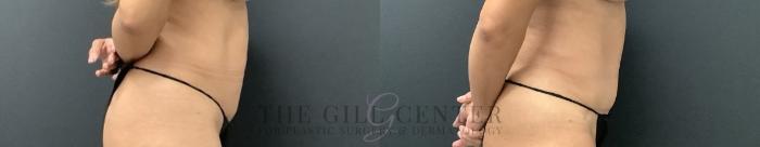 Tummy Tuck Case 727 Before & After Right Side | The Woodlands, TX | The Gill Center for Plastic Surgery and Dermatology