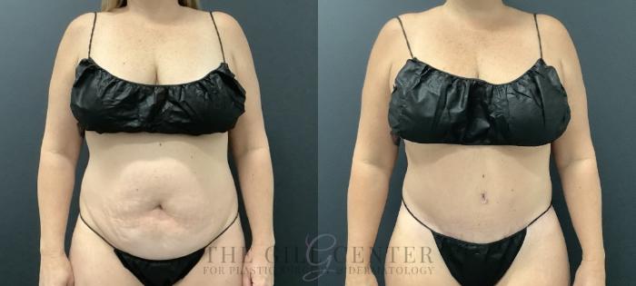 Tummy Tuck Case 729 Before & After Front | The Woodlands, TX | The Gill Center for Plastic Surgery and Dermatology