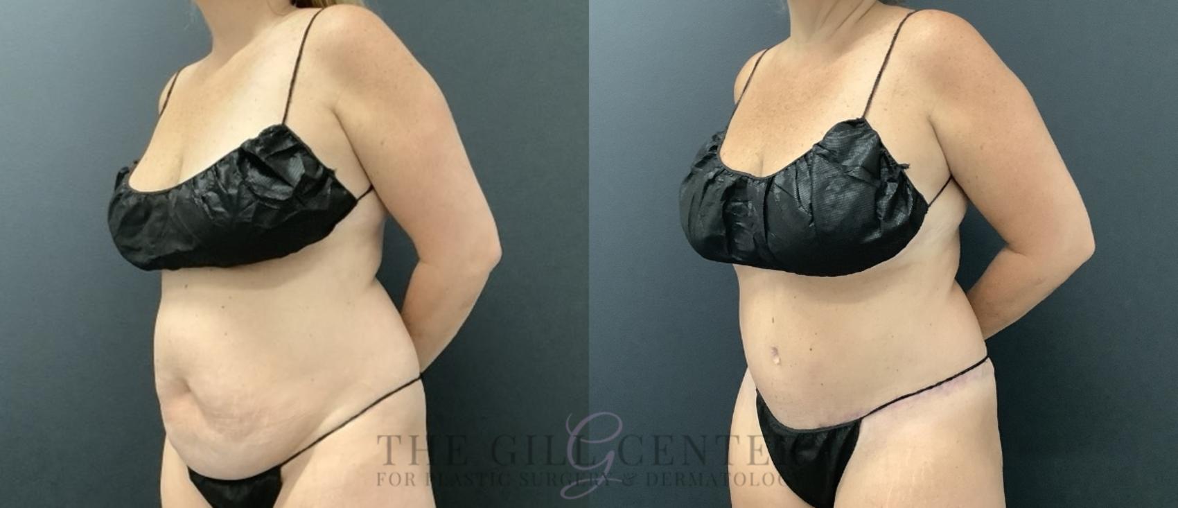 Tummy Tuck Case 729 Before & After Left Oblique | The Woodlands, TX | The Gill Center for Plastic Surgery and Dermatology