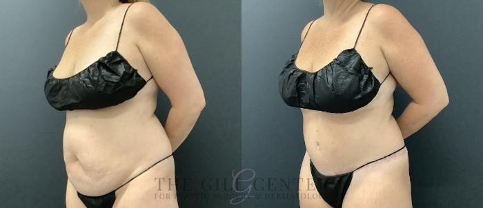 Tummy Tuck Case 729 Before & After Left Oblique | The Woodlands, TX | The Gill Center for Plastic Surgery and Dermatology