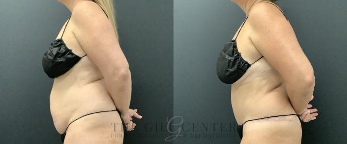 Tummy Tuck Case 729 Before & After Left Side | The Woodlands, TX | The Gill Center for Plastic Surgery and Dermatology