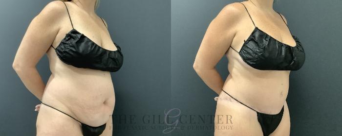 Tummy Tuck Case 729 Before & After Right Oblique | The Woodlands, TX | The Gill Center for Plastic Surgery and Dermatology