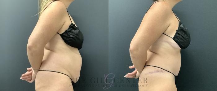 Tummy Tuck Case 729 Before & After Right Side | The Woodlands, TX | The Gill Center for Plastic Surgery and Dermatology