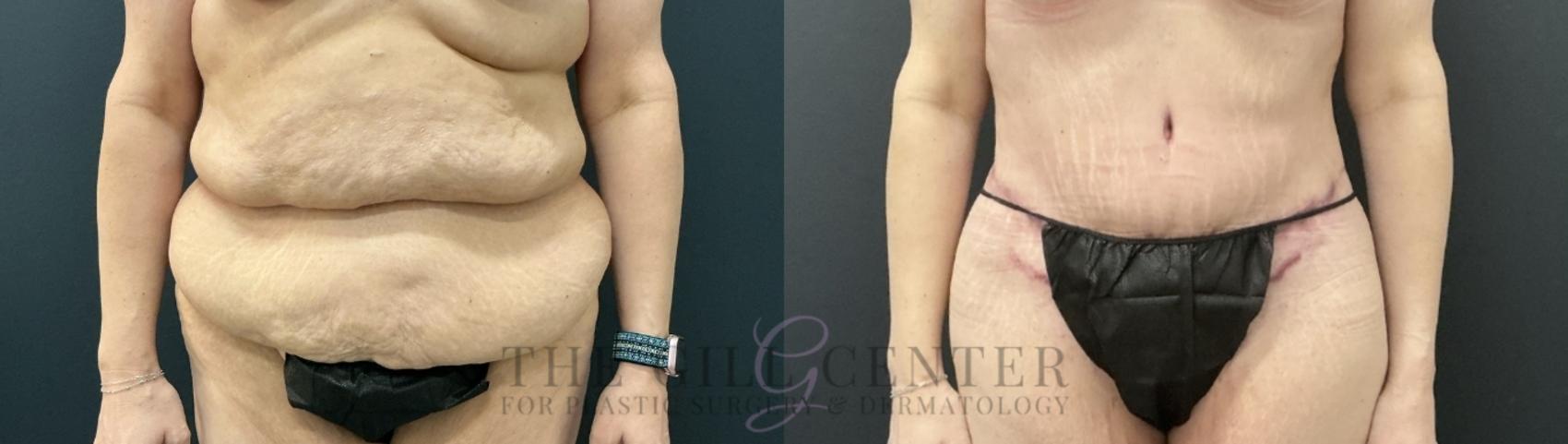 Tummy Tuck Case 737 Before & After Front | The Woodlands, TX | The Gill Center for Plastic Surgery and Dermatology
