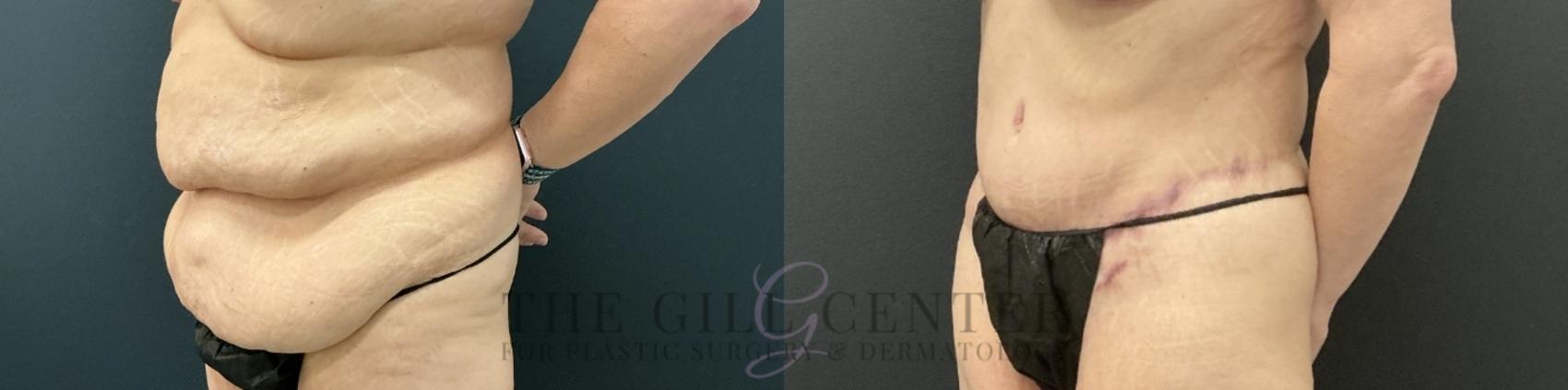 Tummy Tuck Case 737 Before & After Left Oblique | The Woodlands, TX | The Gill Center for Plastic Surgery and Dermatology