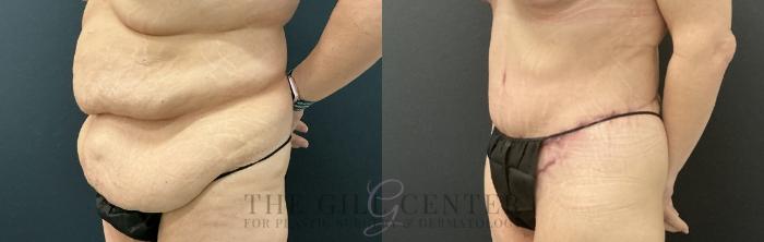 Tummy Tuck Case 737 Before & After Left Oblique | The Woodlands, TX | The Gill Center for Plastic Surgery and Dermatology