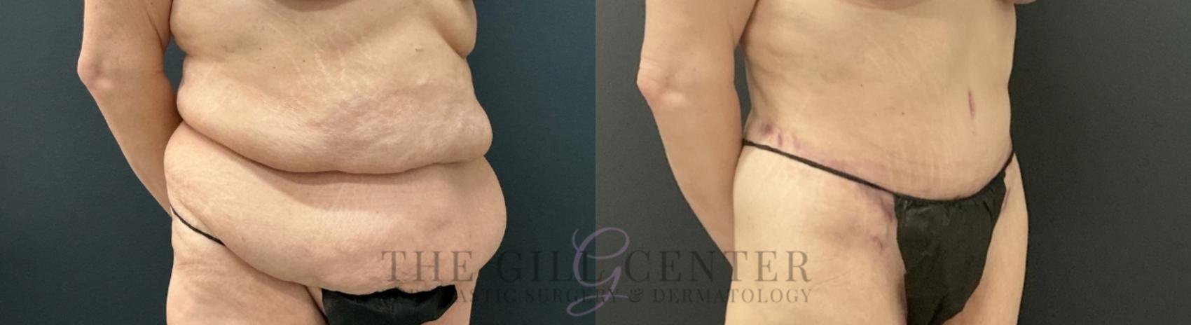 Tummy Tuck Case 737 Before & After Right Oblique | The Woodlands, TX | The Gill Center for Plastic Surgery and Dermatology