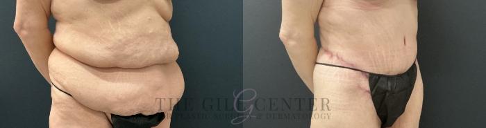 Tummy Tuck Case 737 Before & After Right Oblique | The Woodlands, TX | The Gill Center for Plastic Surgery and Dermatology