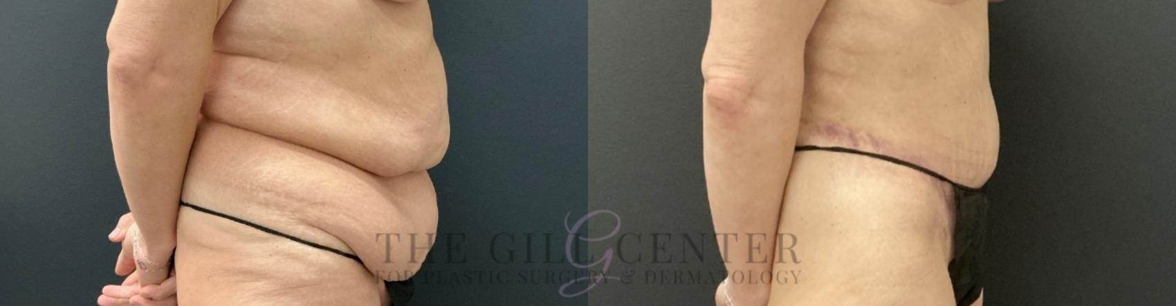 Tummy Tuck Case 737 Before & After Right Side | The Woodlands, TX | The Gill Center for Plastic Surgery and Dermatology