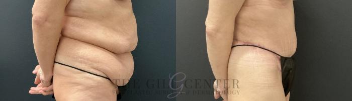 Tummy Tuck Case 737 Before & After Right Side | The Woodlands, TX | The Gill Center for Plastic Surgery and Dermatology