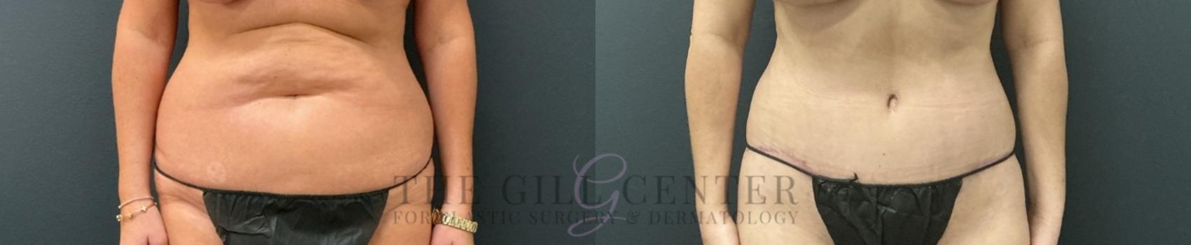 Tummy Tuck Case 751 Before & After Front | The Woodlands, TX | The Gill Center for Plastic Surgery and Dermatology