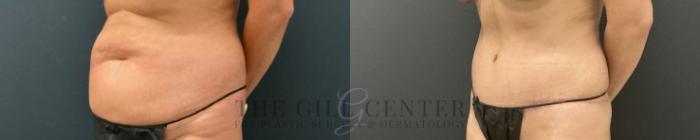Tummy Tuck Case 751 Before & After Left Oblique | The Woodlands, TX | The Gill Center for Plastic Surgery and Dermatology