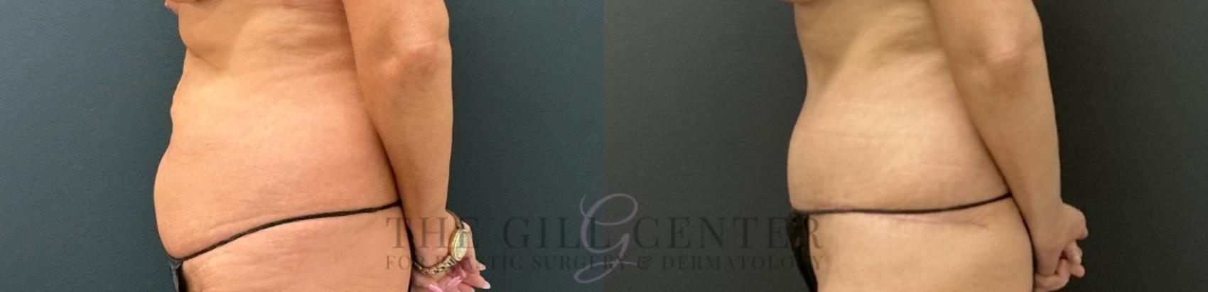 Tummy Tuck Case 751 Before & After Left Side | The Woodlands, TX | The Gill Center for Plastic Surgery and Dermatology