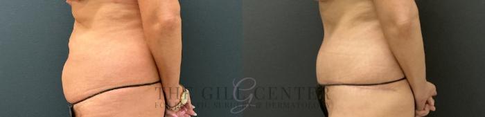 Tummy Tuck Case 751 Before & After Left Side | The Woodlands, TX | The Gill Center for Plastic Surgery and Dermatology