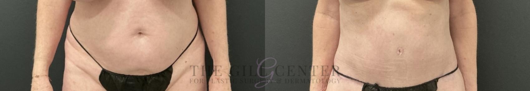 Tummy Tuck Case 759 Before & After Front | The Woodlands, TX | The Gill Center for Plastic Surgery and Dermatology