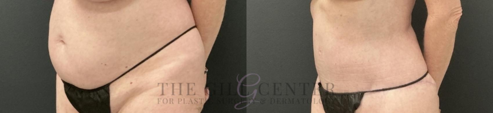 Tummy Tuck Case 759 Before & After Left Oblique | The Woodlands, TX | The Gill Center for Plastic Surgery and Dermatology