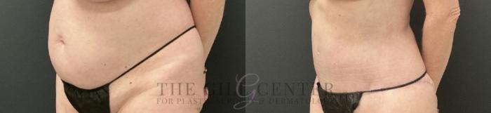 Tummy Tuck Case 759 Before & After Left Oblique | The Woodlands, TX | The Gill Center for Plastic Surgery and Dermatology