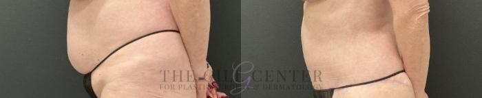 Tummy Tuck Case 759 Before & After Left Side | The Woodlands, TX | The Gill Center for Plastic Surgery and Dermatology
