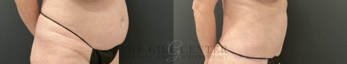 Tummy Tuck Case 759 Before & After Right Oblique | The Woodlands, TX | The Gill Center for Plastic Surgery and Dermatology