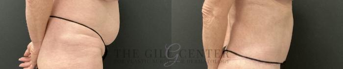 Tummy Tuck Case 759 Before & After Right Side | The Woodlands, TX | The Gill Center for Plastic Surgery and Dermatology