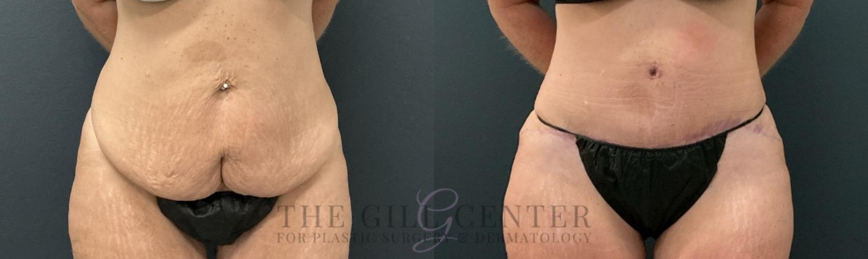Tummy Tuck Case 762 Before & After Front | The Woodlands, TX | The Gill Center for Plastic Surgery and Dermatology