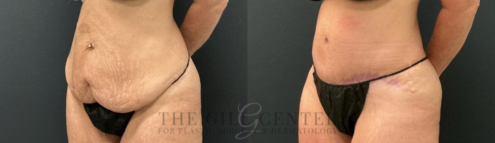Tummy Tuck Case 762 Before & After Left Oblique | The Woodlands, TX | The Gill Center for Plastic Surgery and Dermatology
