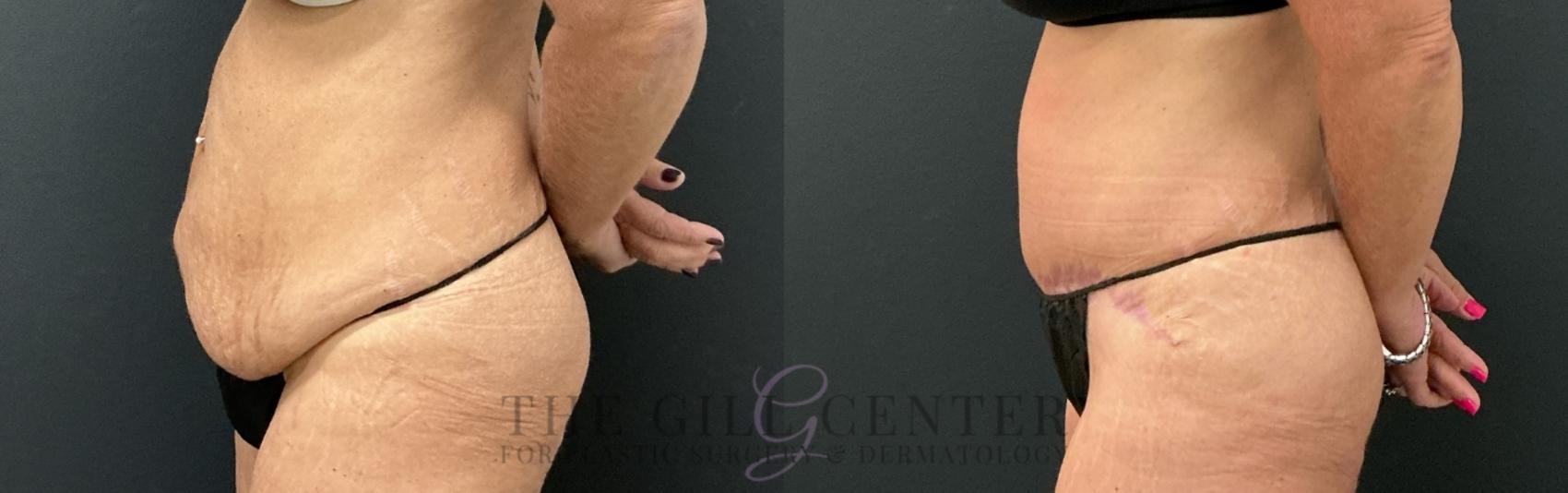 Tummy Tuck Case 762 Before & After Left Side | The Woodlands, TX | The Gill Center for Plastic Surgery and Dermatology