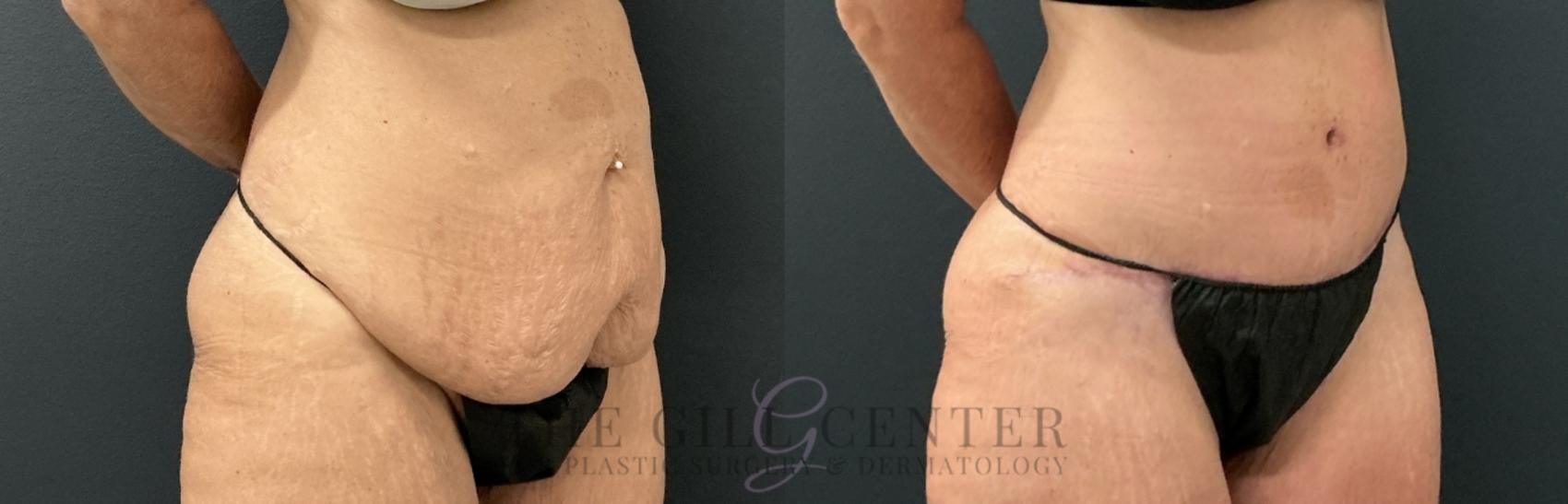 Tummy Tuck Case 762 Before & After Right Oblique | The Woodlands, TX | The Gill Center for Plastic Surgery and Dermatology