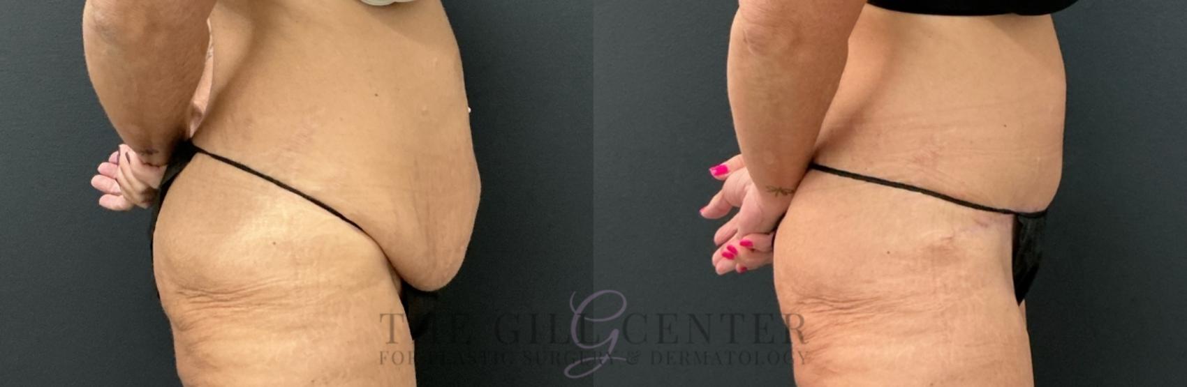 Tummy Tuck Case 762 Before & After Right Side | The Woodlands, TX | The Gill Center for Plastic Surgery and Dermatology