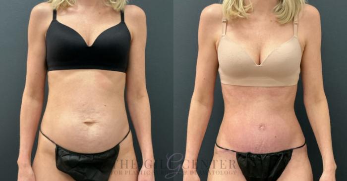 Tummy Tuck Case 778 Before & After Front | The Woodlands, TX | The Gill Center for Plastic Surgery and Dermatology