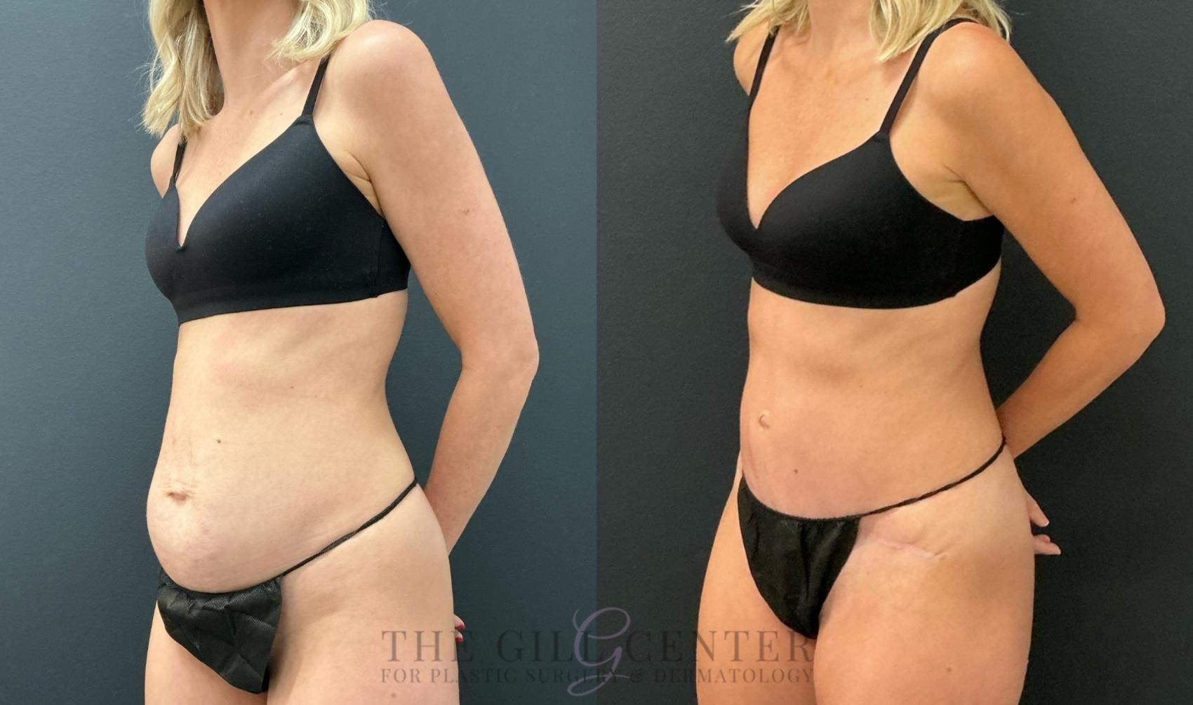 Tummy Tuck Case 778 Before & After Left Oblique | The Woodlands, TX | The Gill Center for Plastic Surgery and Dermatology