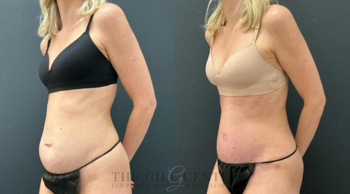 Tummy Tuck Case 778 Before & After Left Oblique | The Woodlands, TX | The Gill Center for Plastic Surgery and Dermatology
