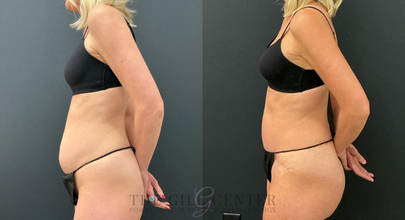 Tummy Tuck Case 778 Before & After Left Side | The Woodlands, TX | The Gill Center for Plastic Surgery and Dermatology