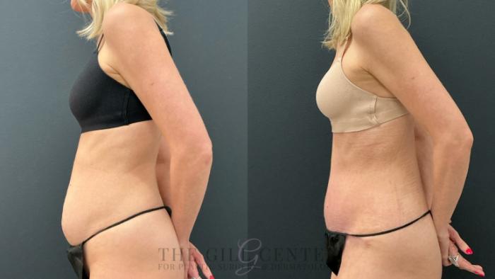 Tummy Tuck Case 778 Before & After Left Side | The Woodlands, TX | The Gill Center for Plastic Surgery and Dermatology