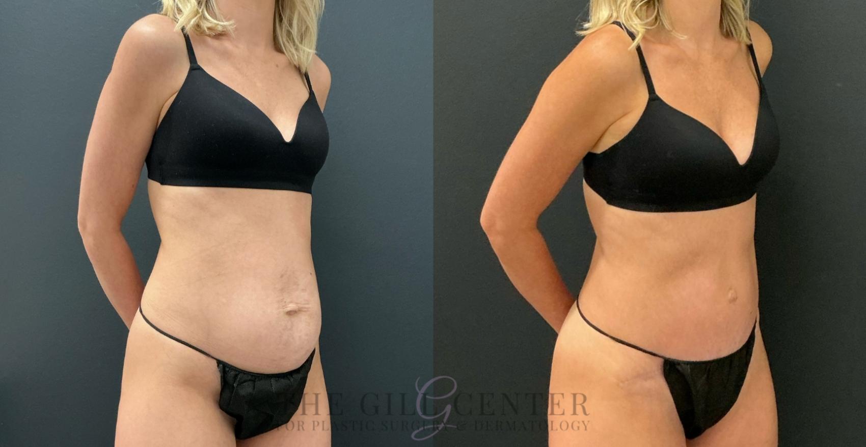 Tummy Tuck Case 778 Before & After Right Oblique | The Woodlands, TX | The Gill Center for Plastic Surgery and Dermatology